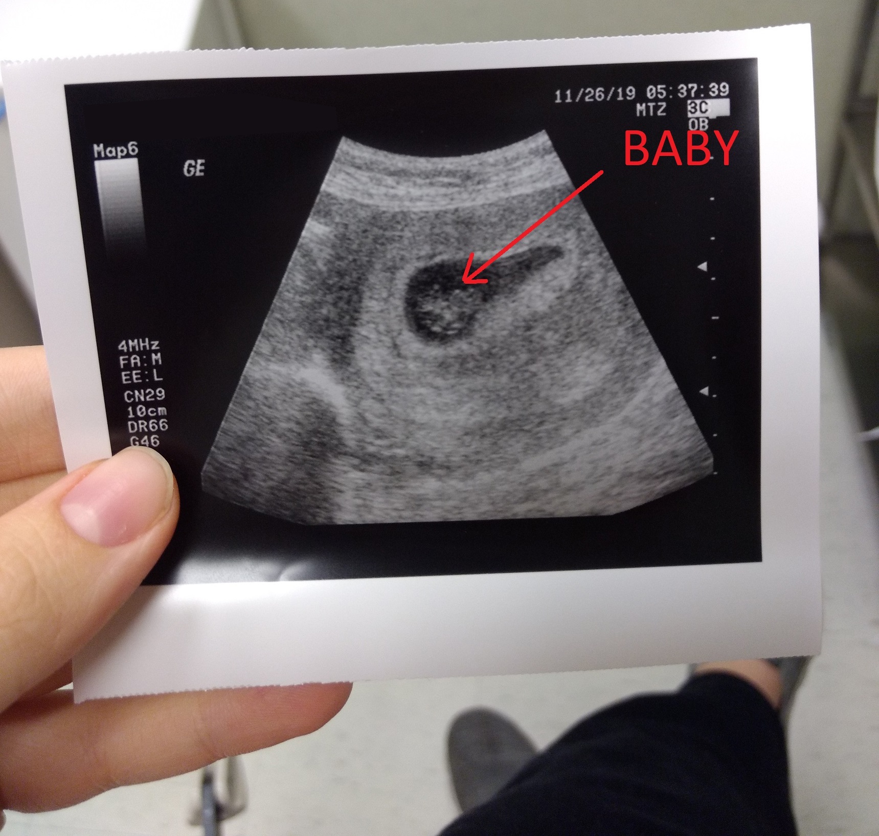 List 97+ Pictures Twin Ultrasound Pictures At 8 Weeks Updated